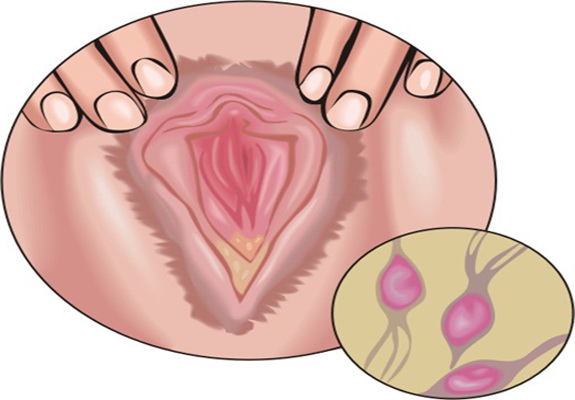 Tricomoniasis Nvsh Todo Sobre El Sexo